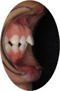 MEAWな矯正仲間～まもなくワイヤーはずします～